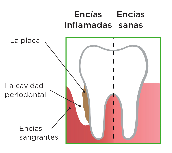 es-gum-disease-graphic.jpg