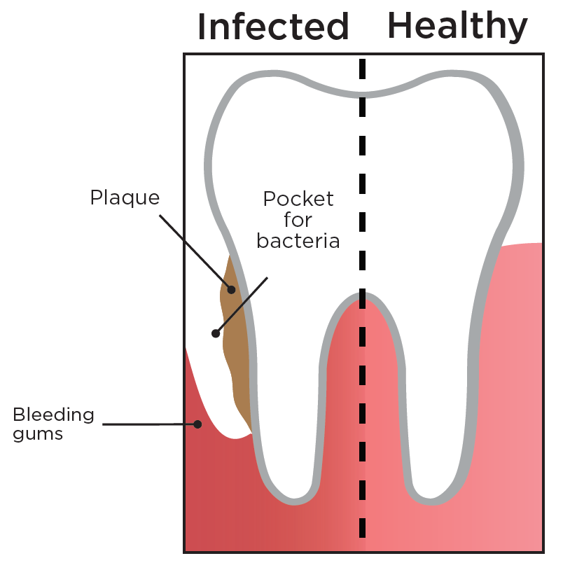 gum-disease-graphic.png